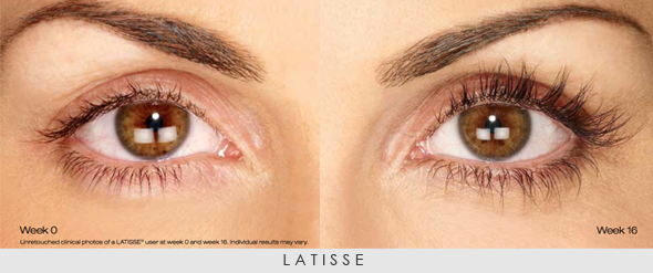 latisse-befor-and-after